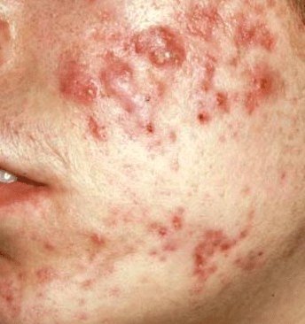 remove acne